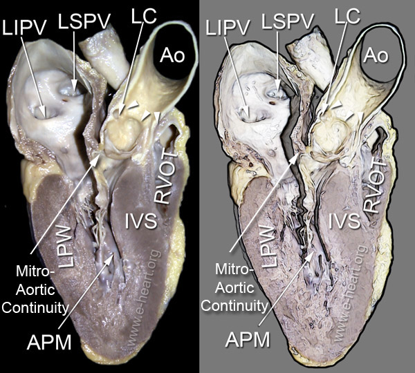 Left Ventricle Right lateral